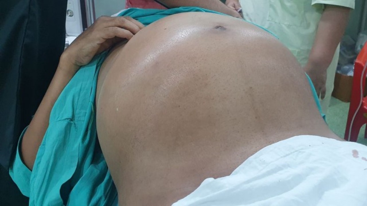 Tumor seberat 10 kg berhasil dikeluarkan dari perut. (Caters News Agency)