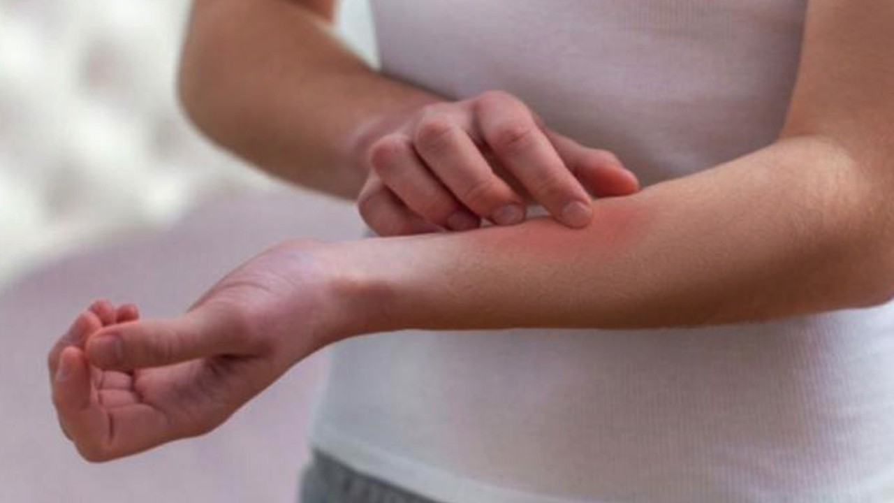 Ilustrasi gatal pada kulit. (kompasiana.com)