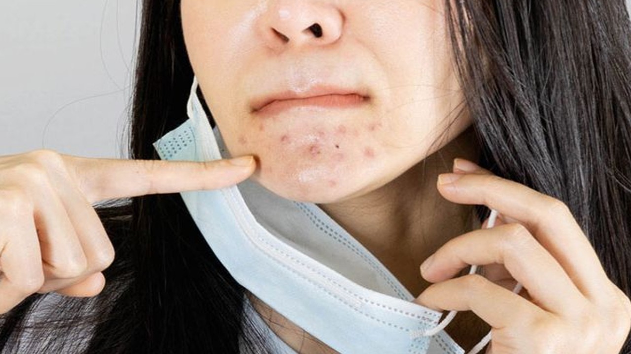 ilustrasi jerawat (health.clevelandclinic.org)