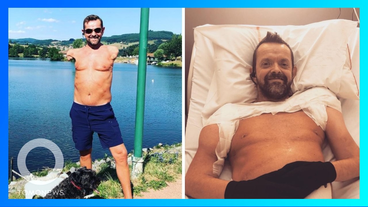 Felix Gretarsson sukses menjalani transplantasi dua lengan/ist