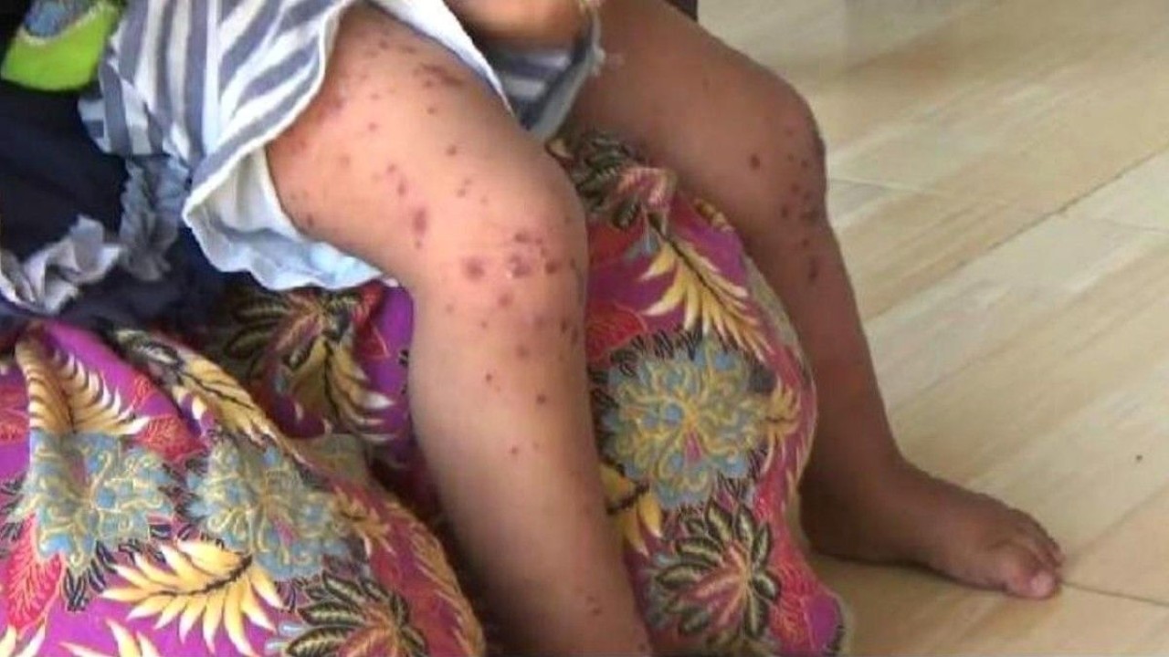 Ilustrasi anak penderita flu Singapura/ist