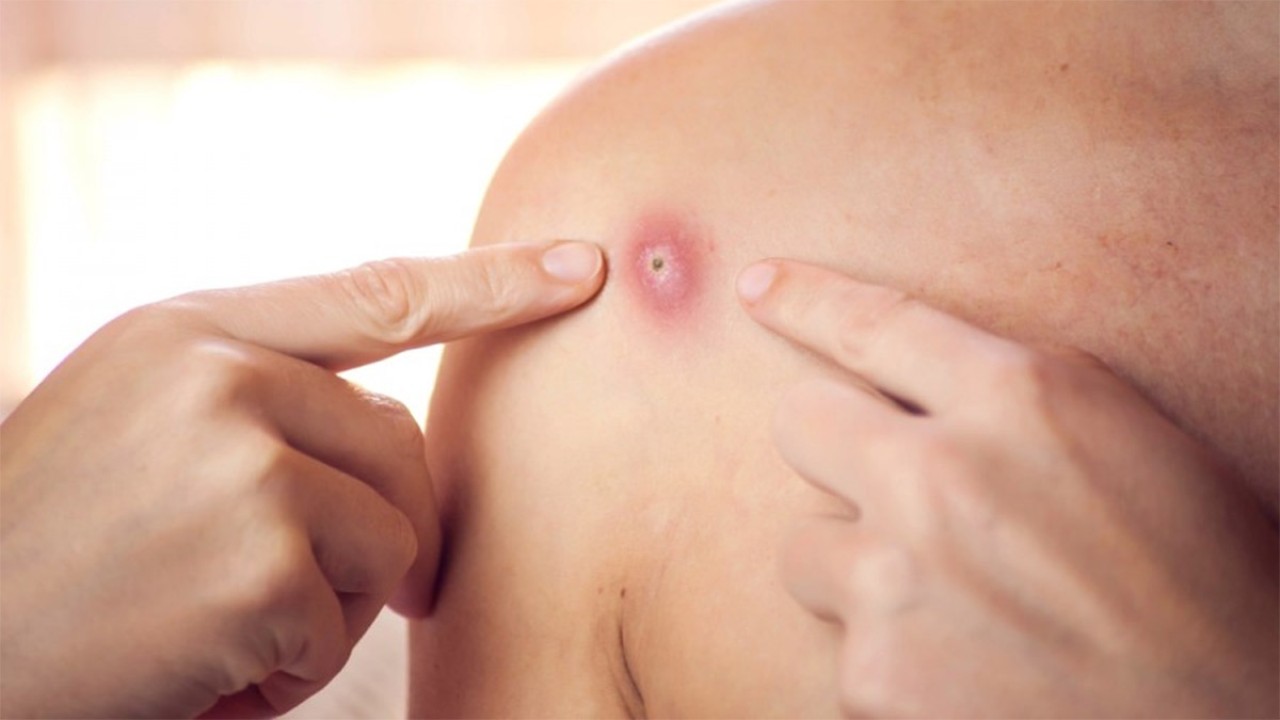 Penderita cacar monyet/ist