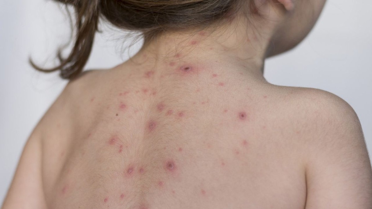 Penderita cacar monyet/ist