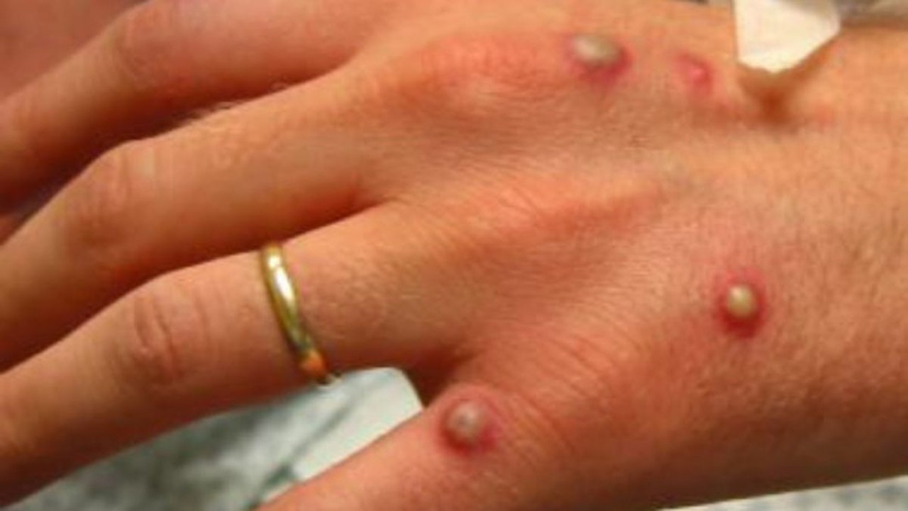 Penyakit cacar monyet/ist