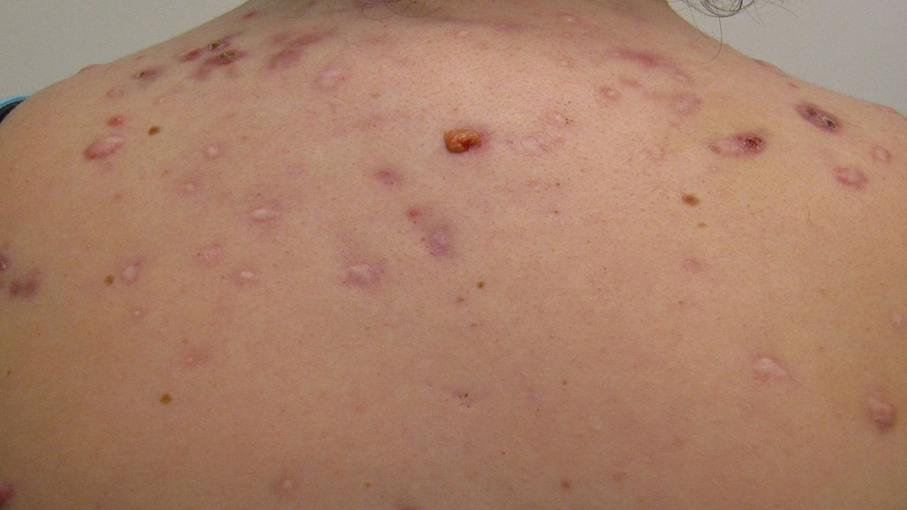 Ilustrasi penderita cacar monyet/ist