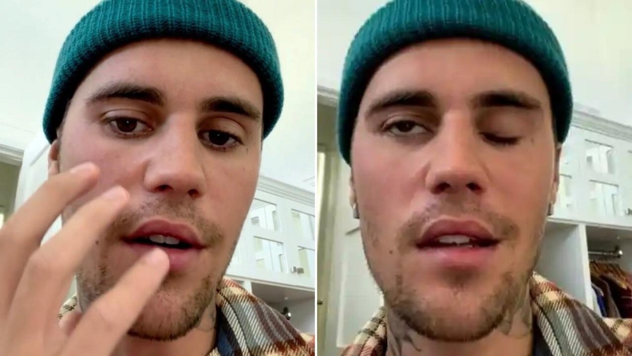 Justin Bieber menderita penyakit Ramsay Hunt/ist