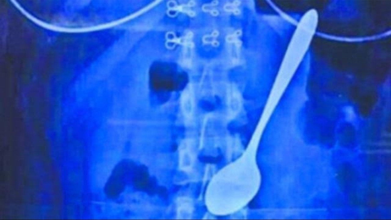 Ilustrasi sendok dalam perut/net