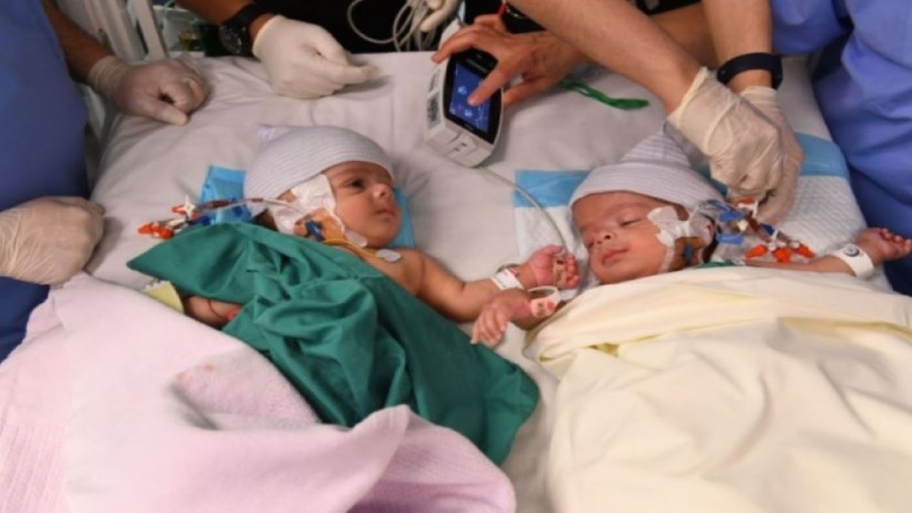 Bayi kembar siam asal Yaman, Salman dan Abdullah sukses menjalani operasi pemisahan pada Kamis (16/2/2023). (Saudi Gazette).