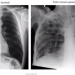 Ilustrasi - Foto scan perbedaan kondisi paru-paru pasien normal dan penderita Tuberkulosis (TBC). (ANTARA/HO-Kemenkes).-1679372048