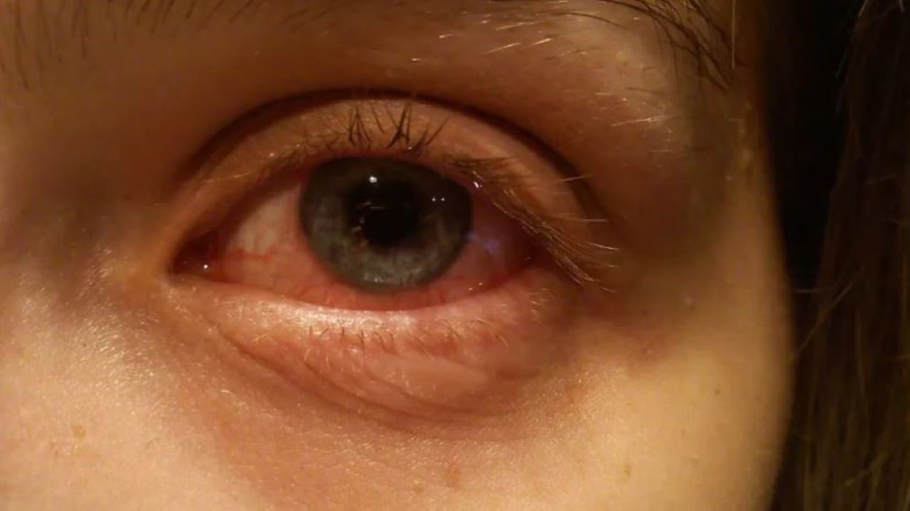 Ilustrasi. Sakit mata. (Medical News Today)