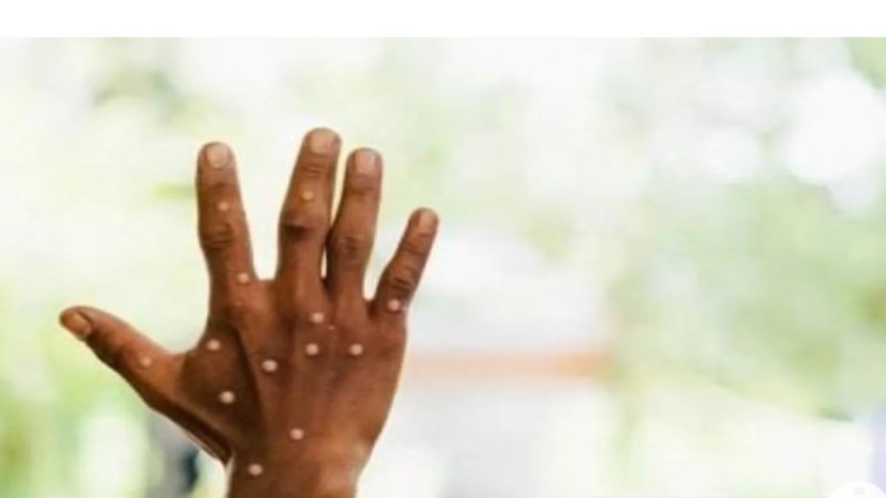 Ilustrasi - Penderita cacar monyet atau monkeypox. (ANTARA/HO-Sutterstock/aa)