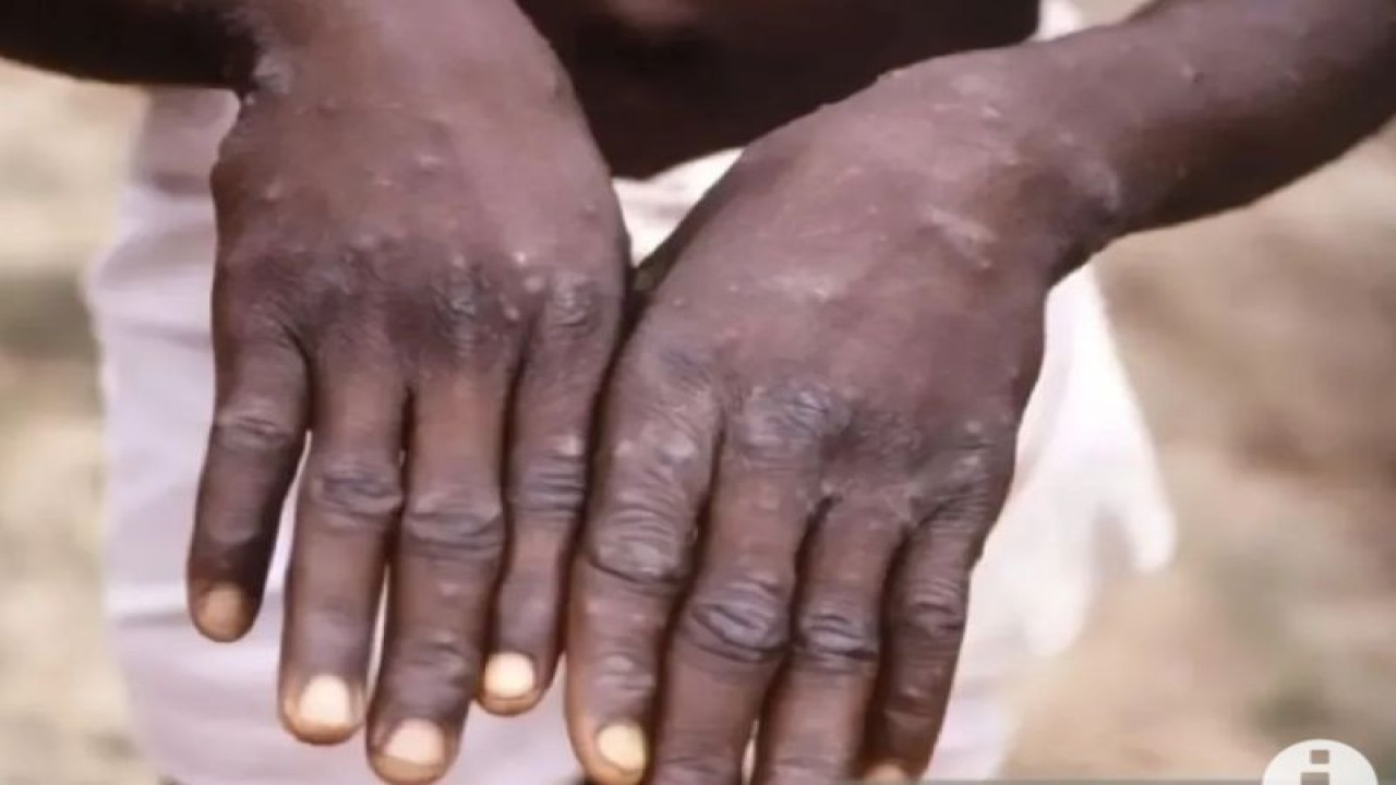 Ilustrasi - Pengidap virus cacar monyet (monkeypox). (ANTARA/Sutterstock/aa)