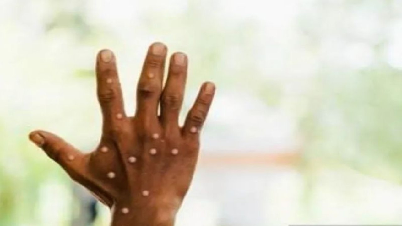 Ilustrasi: Penderita cacar monyet atau monkeypox. ANTARA/Dokumentasi Pribadi