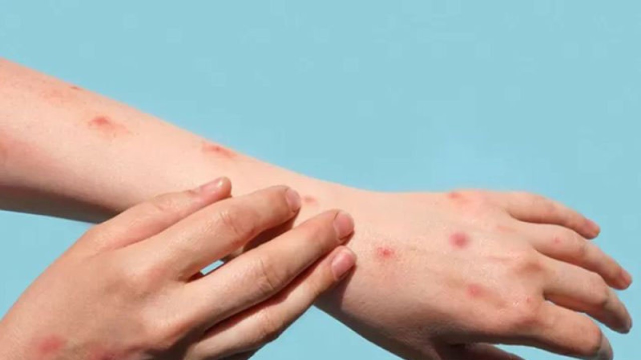 Ilustrasi - Cacar Monyet atau Monkeypox. ANTARA/freepick/pri. (ANTARA/freepick)