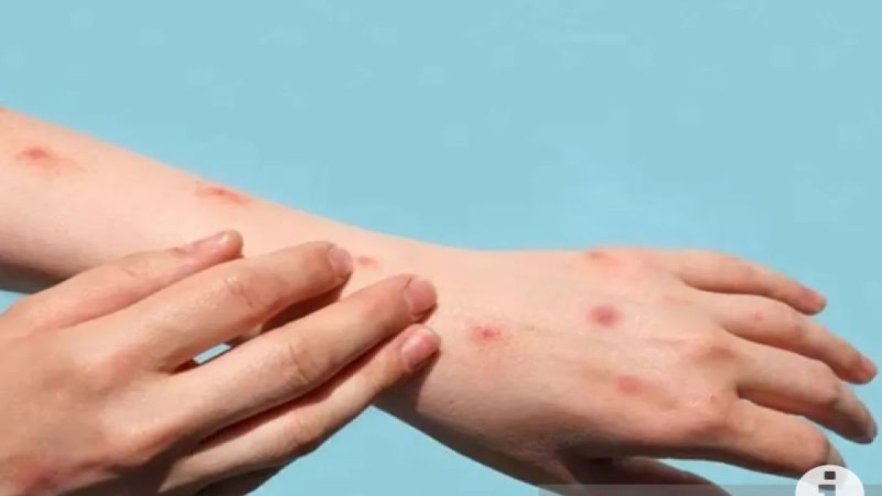 Ilustrasi - Cacar Monyet atau Monkeypox. ANTARA/freepick/pri