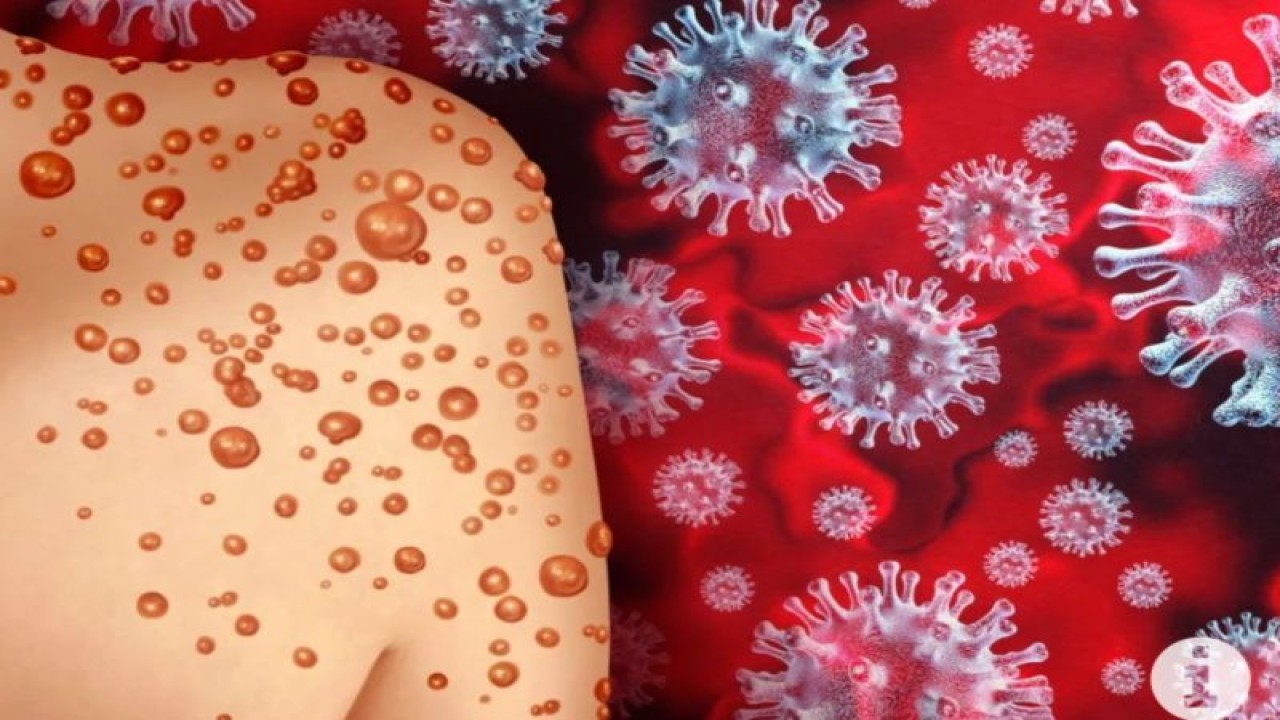 Ilustrasi - Cacar monyet atau monkeypox. (ANTARA/HO-Shutterstock)