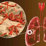 Ilustrasi- penyakit tuberkulosis. (ANTARA/HO)-1699430354